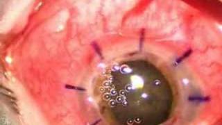 Cornea Transplant