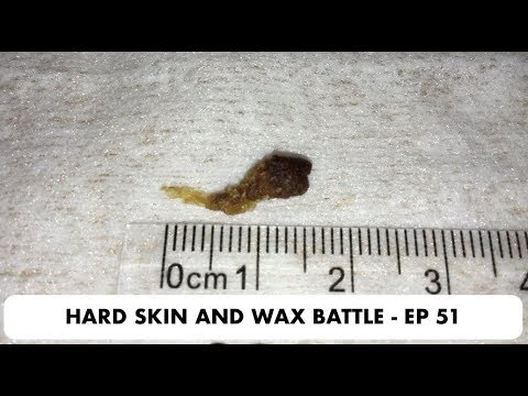 HARD SKIN AND EAR WAX REMOVAL BATTLE - EP 51