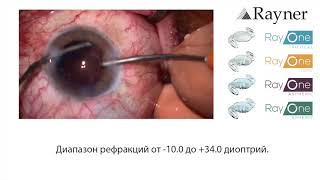 Ультразвуковая факоэмульсификация с имплантацией предустановленной в инжекторе ИОЛ Rayner RayOne Aspheric.