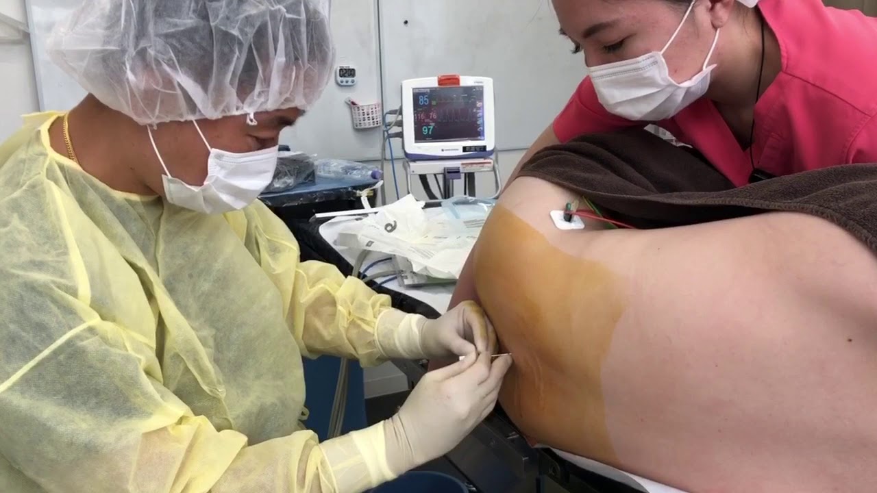 新潟からご来院！太すぎてどうにもならない太ももは脂肪吸引で確実に細くする！術中劇的変化