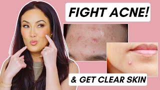 Top Skincare Ingredients to Fight Acne & Get Clear Skin!