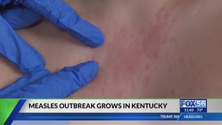 Kentucky measles outbreak grows to 24 cases across 7 counties