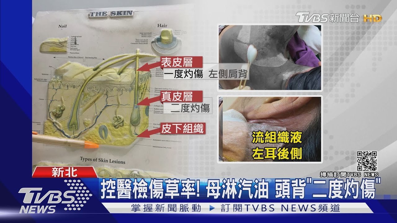 控醫檢傷草率!母淋汽油 頭背「二度灼傷」