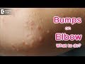 Small raised bumps on elbow - Causes & Treatment - Dr. Rajdeep Mysore