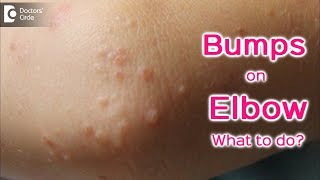 Small raised bumps on elbow - Causes &amp; Treatment - Dr. Rajdeep Mysore