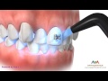 Orthodontic Treatment for Crowding - Different Stages