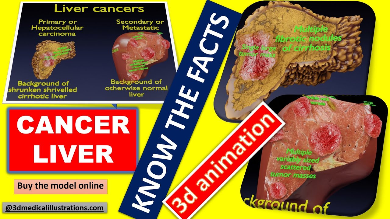 3D Liver cancer HCC vs Metastatic 3D Model