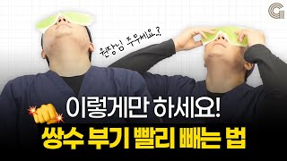 쌍꺼풀수술 후 붓기 빨리 빼는법! 자세하게 알려드릴께요! /그리다성형외과