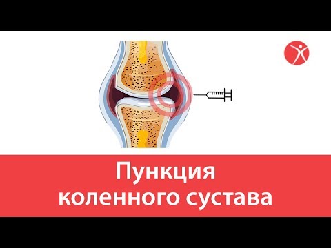 Боли и хруст в грудном отделе позвоночника Осложнения разрыва связок коленного сустава