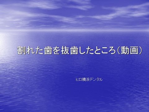 歯学科 ヒロ横浜デンタル　歯の根が割れて抜くことになった箇所に自分の親知らずを移植(No.2)