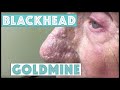 A Goldmine of Blackhead & Whitehead Extractions
