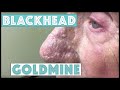 A Goldmine of Blackhead & Whitehead Extractions ...