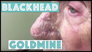 A Goldmine of Blackhead &amp; Whitehead Extractions