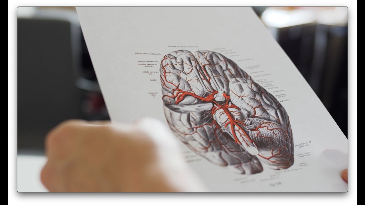 Deep Brain Vessel Profiler. Schlaganfälle mit Deep Learning individuell behandeln