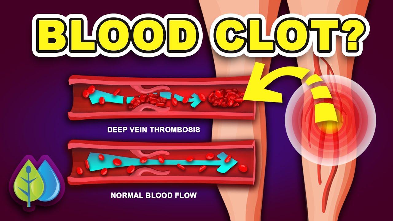 Putar video Top 10 signs of a BLOOD CLOT in your leg (prevent Deep Vein Thrombosis) sekarang Top 10 signs of a BLOOD CLOT in your leg (prevent Deep Vein Thrombosis)