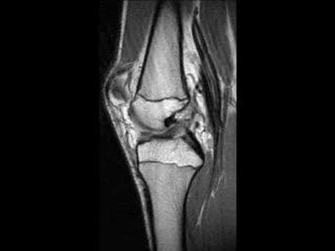 Osteocondrosi delle toracica della colonna vertebrale 2 fasi Il trattamento della patologia degenerativa del disco yoga