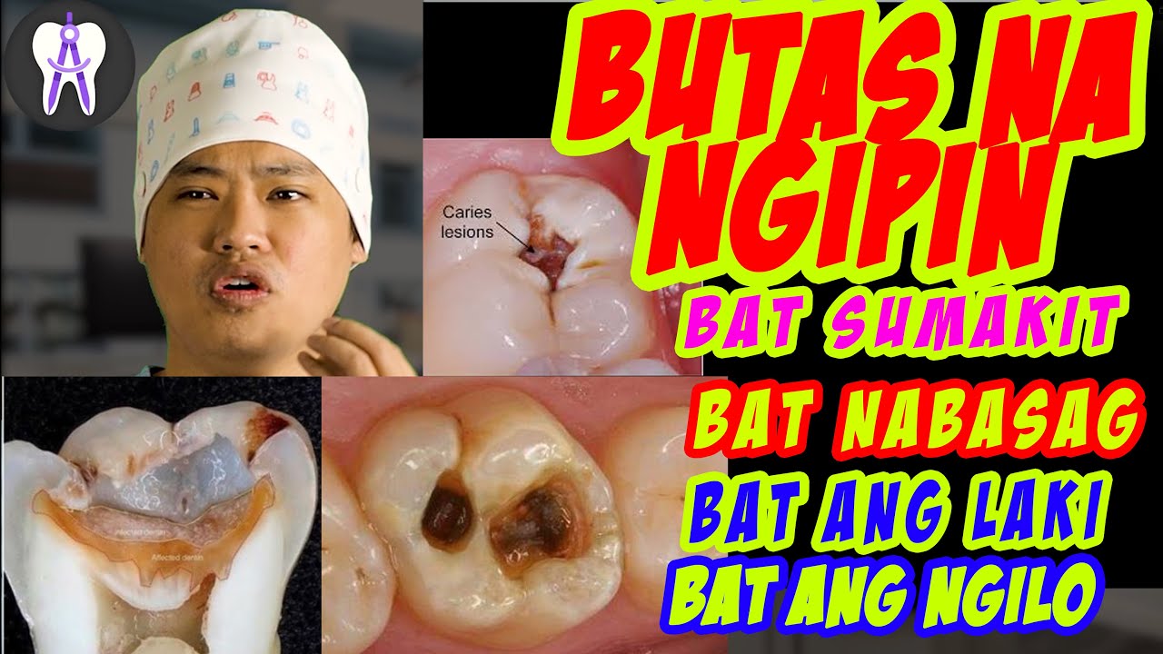Putar video Paano Lumaki Ang Sira ng Ngipin.. At Mga Dapat Malaman Tunkol Dito(English subtitle) #48 sekarang Paano Lumaki Ang Sira ng Ngipin.. At Mga Dapat Malaman Tunkol Dito(English subtitle) #48