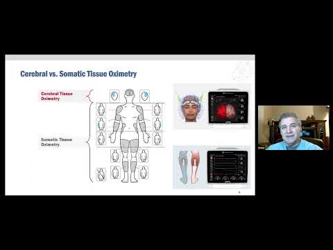Tissue oximetry StO2 monitoring in the ECMO patient