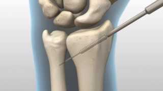 Acutrak 2.0 screw for a Radial Fracture