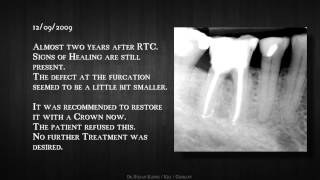 preview picture of video '5,5 years recall of a lower first molar'