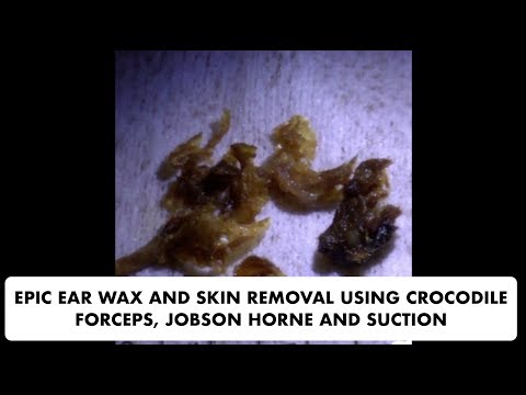 EPIC SKIN AND EAR WAX REMOVAL USING JOBSON HORNE, SUCTION AND CROCODILE FORCEPS - Ep 23