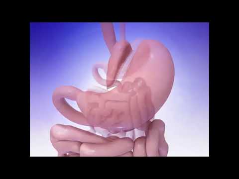 Understanding Mini Gastric Bypass Surgery