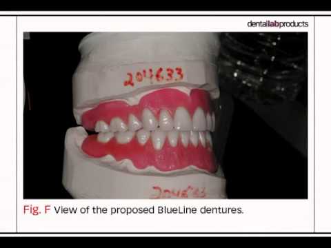 Bench Mastery: Fabricate an Esthetic, Implant-Supported PFM Restoration