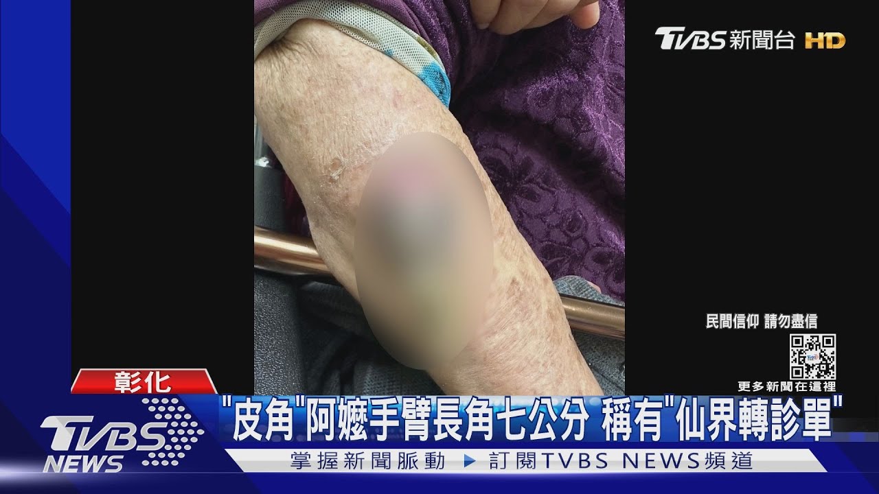 「皮角」阿嬤手臂長角七公分　稱有「仙界轉診單」
