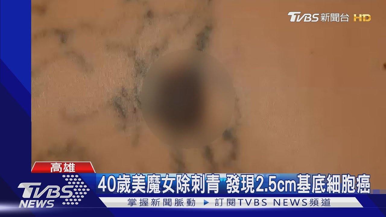 40歲美魔女除刺青 發現2.5cm基底細胞癌