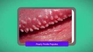 How to Get Rid of Pearly Penile Papules