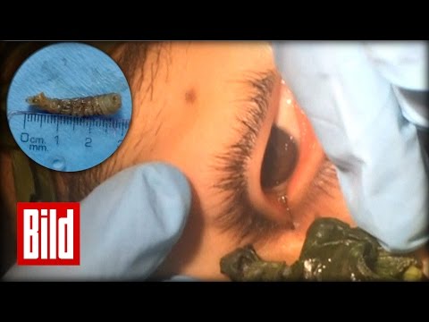 , title : 'Wurm im Auge - Ekel Operation - Ärzte holen Wurm mit Basilikum raus'