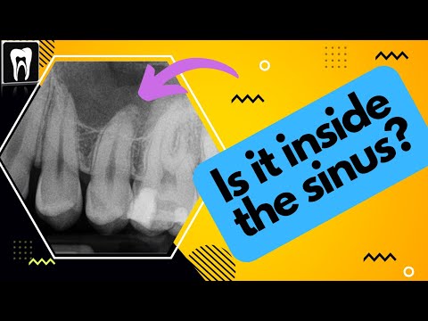 Is The Root Inside The Maxillary Sinus Or Not | Maxillary Sinus and Upper Molars Relation |