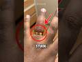 How To Remove A Ring Stuck On Finger