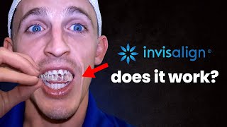 Watch this before you Buy Invisalign…Orthodontist reviews