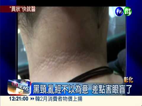 頸黑.長鬚.經期亂 當心卵巢病變