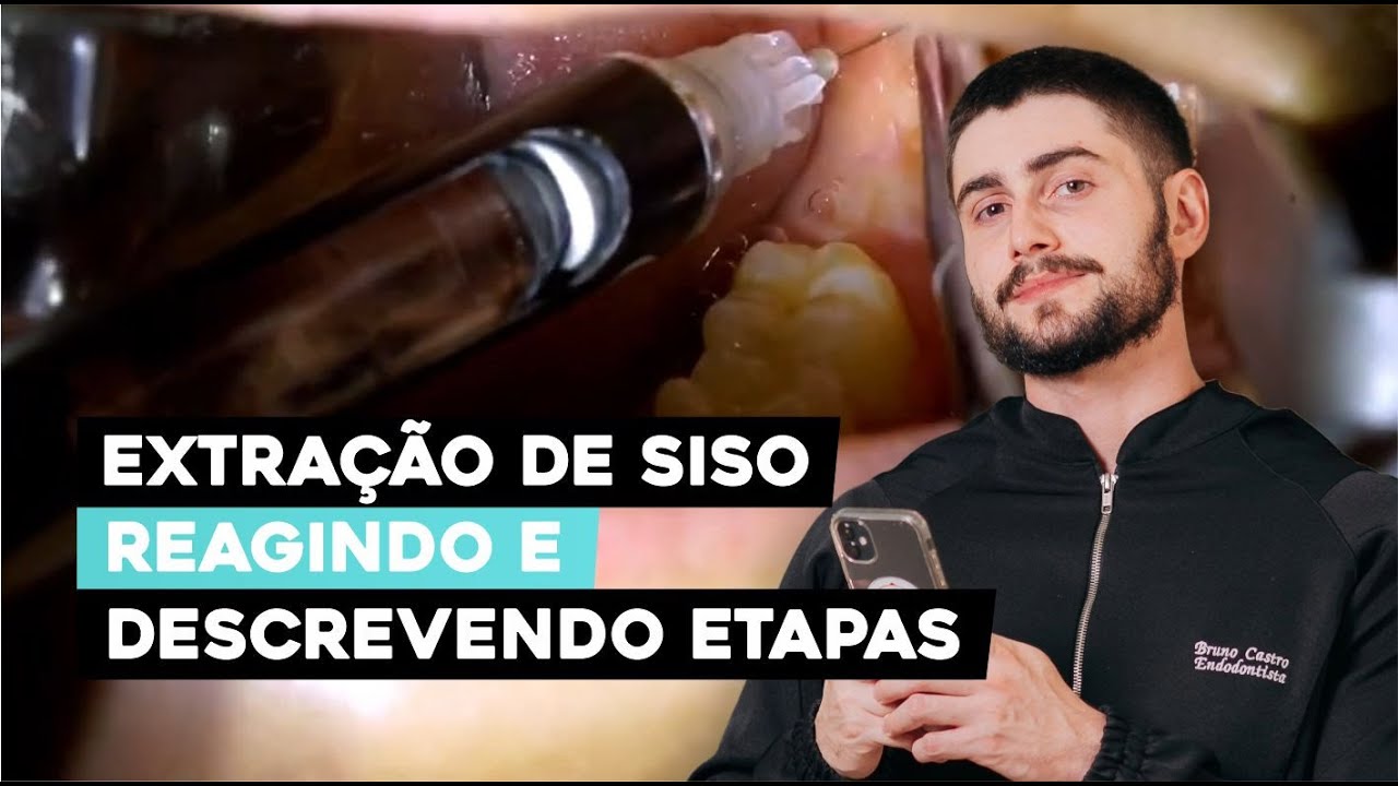 Reagindo à Extração de Siso Incluso: O Que Você Precisa Saber!