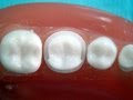 Metal Ceramic Crown Preparation For Dental Students
