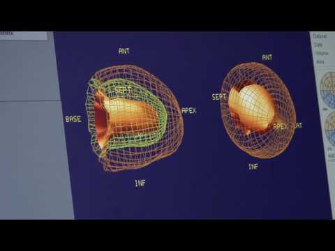 Catheter Ablation for Ventricular Ectopic Beats