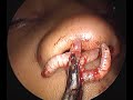 MAGGOTS in a 5yr Old kid | Maggots eating healthy tissue inside Nose