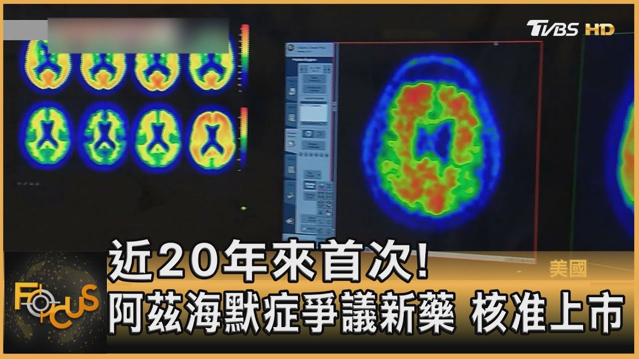 近20年來首次! 阿茲海默症爭議新藥 核准上市