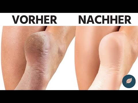 Rissige Hornhaut an den Fersen  behandeln - Das Heilmittel steht schon bei dir im Küchenschrank!