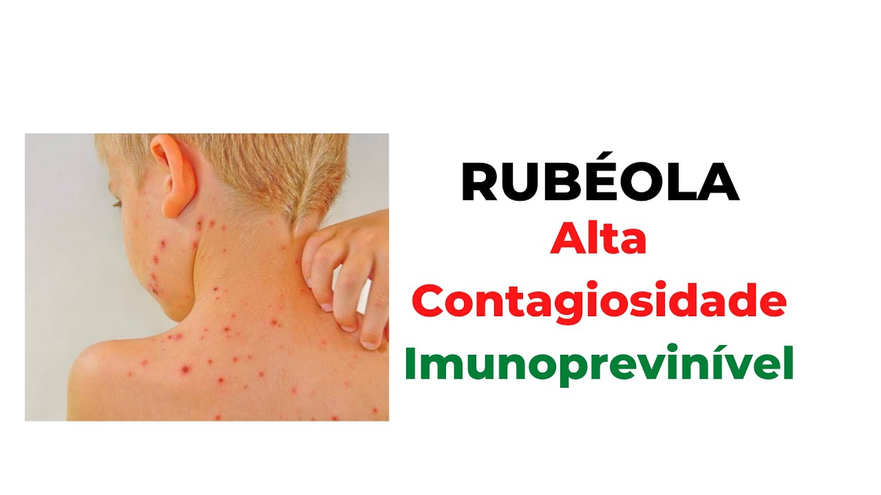 RUBÉOLA: TRANSMISSÃO, TRATAMENTO E PREVENÇÃO - AULA COMPLETA