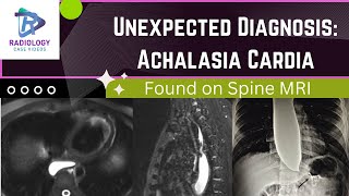 Unexpected Diagnosis : ACHALASIA CARDIA     |    #radiology #mri #Umamaheswarareddy.V