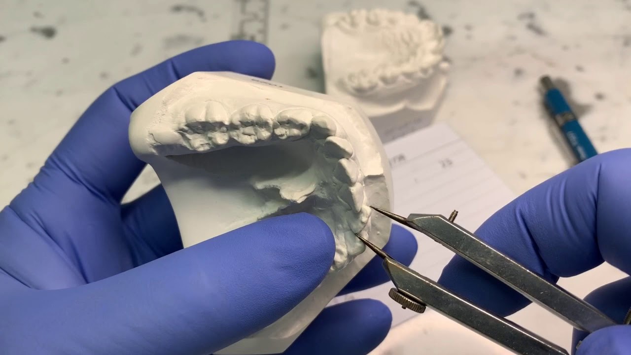 Watch Now Análise de Moyers da dentição mista Análise de Moyers da dentição mista