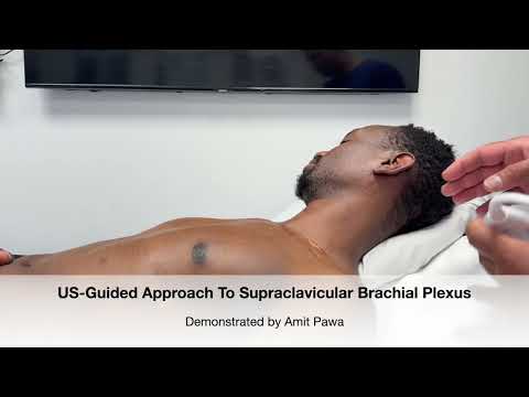 New Scanning Tutorial for Supraclavicular Brachial Plexus Block