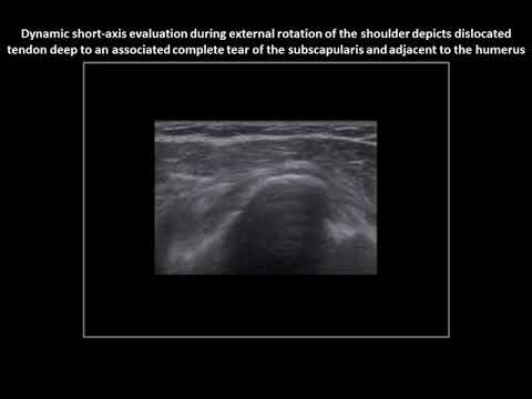 Intra-articular dislocation (instability) of the long head of biceps brachii tendon on ultrasound