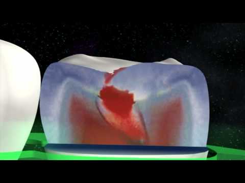 KaVo DIAGNOdent pen: Find hidden caries