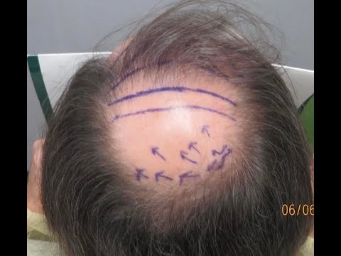 Man gets crown hair restoration using FUE method with...