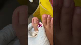 Ep_8185 Ingrown toenail removal 👣 Why do nails become deformed? 😄 (clip from Thailand)