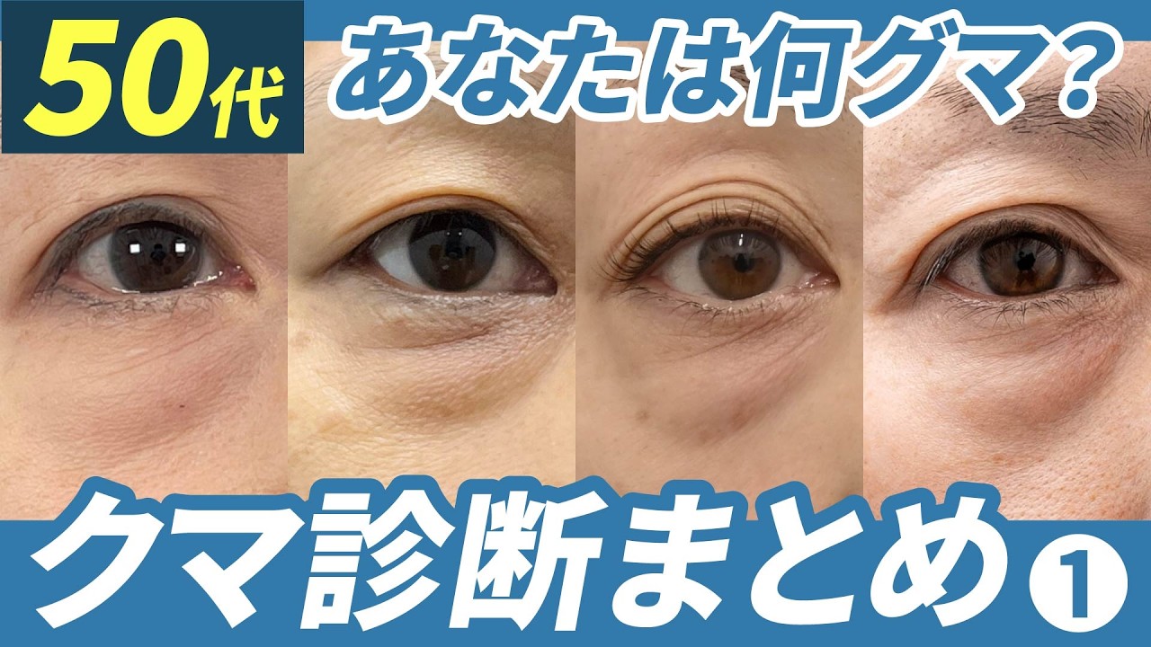 【50代のクマ取り】年齢で深刻化する原因と、実際に変わった症例を医師が解説 #クマ取り #クマ取整形 #目の下のクマ #裏ハムラ #脂肪注入#美容整形#湘南美容クリニック
